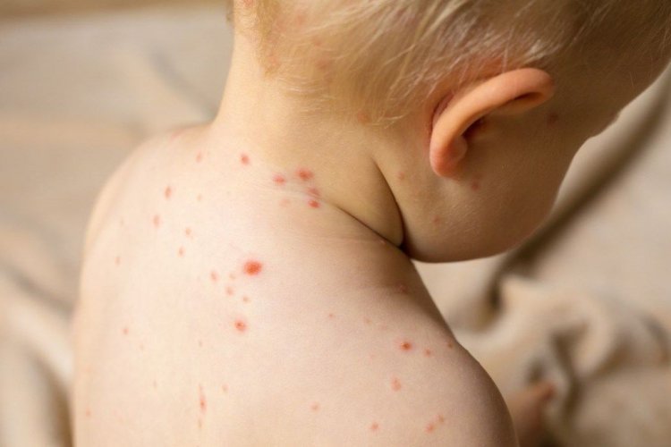 KIZAMIKLA GELEN HASTALIKLARA DİKKAT